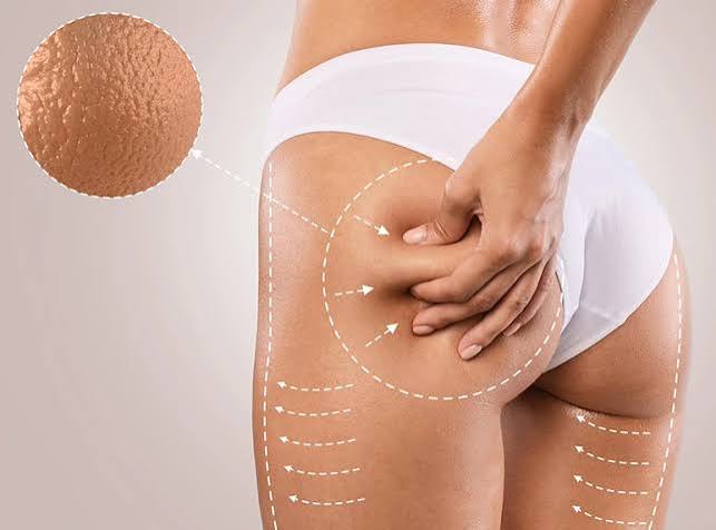WellDome a Infrarossi e benefici per cellulite estetica